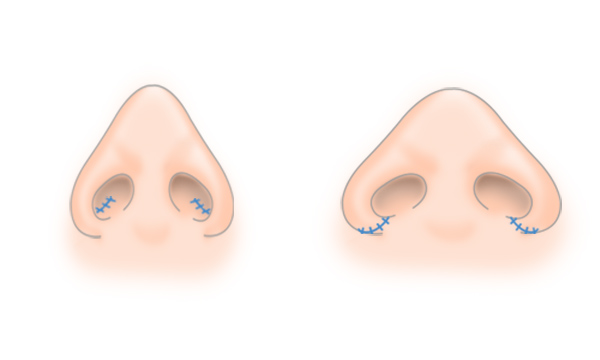 鼻翼縮小の手術方法 STEP1