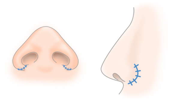 鼻翼縮小の手術方法 STEP5