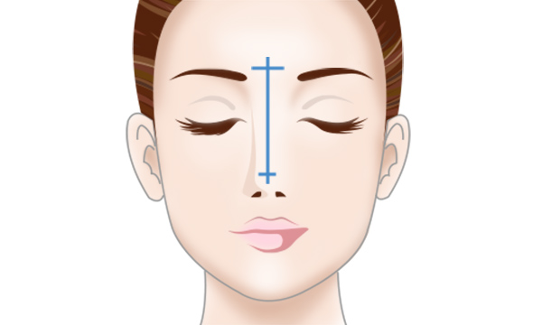 自家軟骨による隆鼻術の手術方法 STEP3