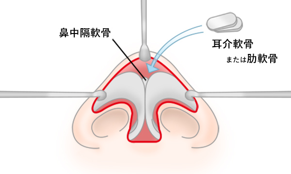 鼻中隔延長の手術方法 STEP5