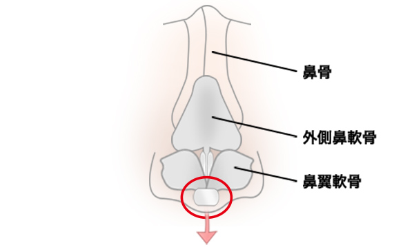 鼻中隔延長の手術方法 STEP6