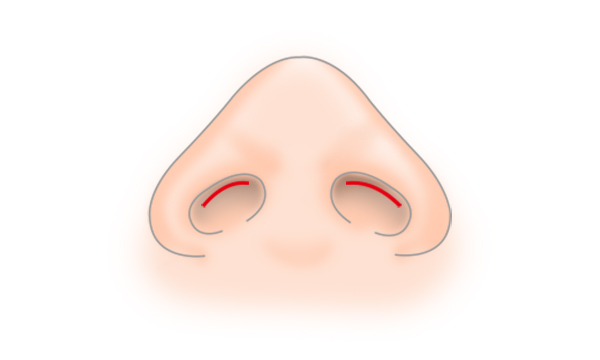 鼻孔縁形成の手術方法 STEP2