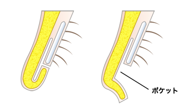 鼻孔縁形成の手術方法 STEP3