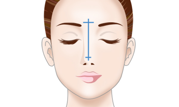 プロテーゼ隆鼻術の手術方法 STEP1
