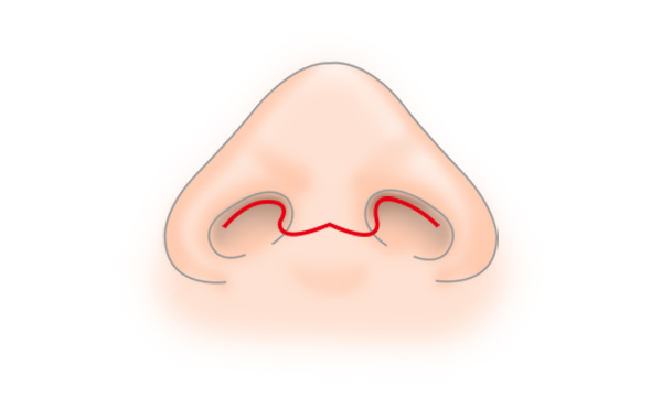 斜鼻修正の手術方法 STEP6