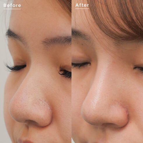 鼻の整形 症例写真