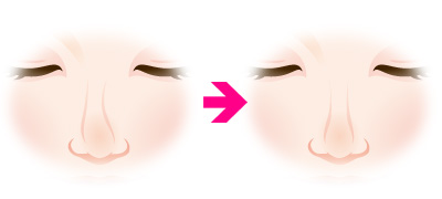 斜鼻修正