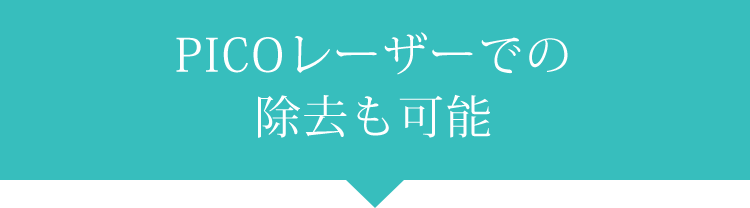 PICOレーザーでの除去も可能