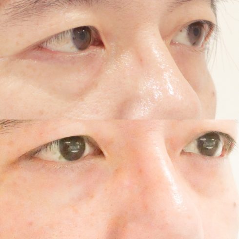 下眼瞼除皺術 東京 銀座 目の下のたるみ治療なら東京イセアクリニック