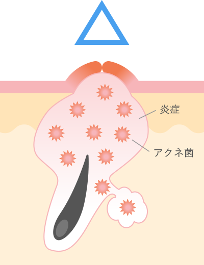 赤（炎症）ニキビ