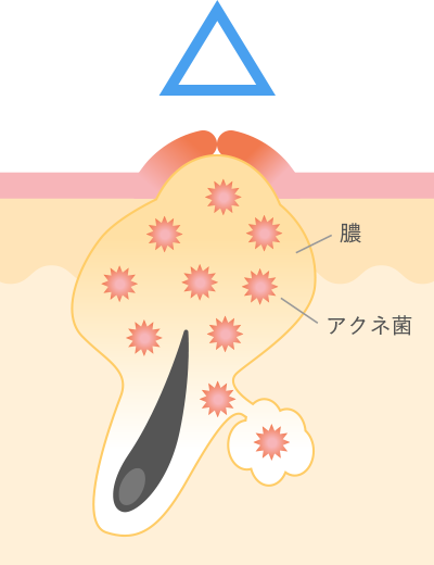 黄（化膿）ニキビ