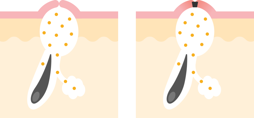 白ニキビと黒ニキビ