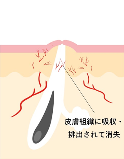 IPL光治療の炎症に対する仕組み 皮膚組織に吸収・排出されて消失