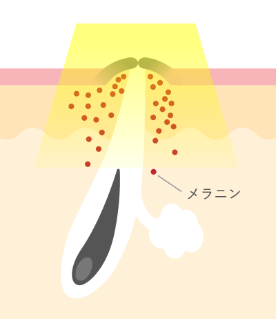 IPL光治療の炎症に対する仕組み メラニン