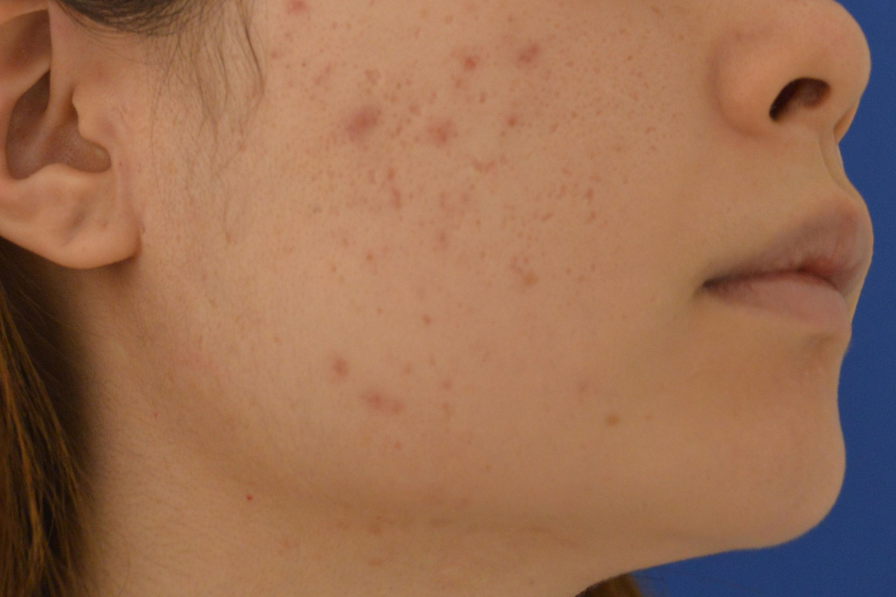 定額制ニキビ ニキビ跡 03 ニキビ治療 ニキビ跡治療の東京イセアクリニック 症例写真
