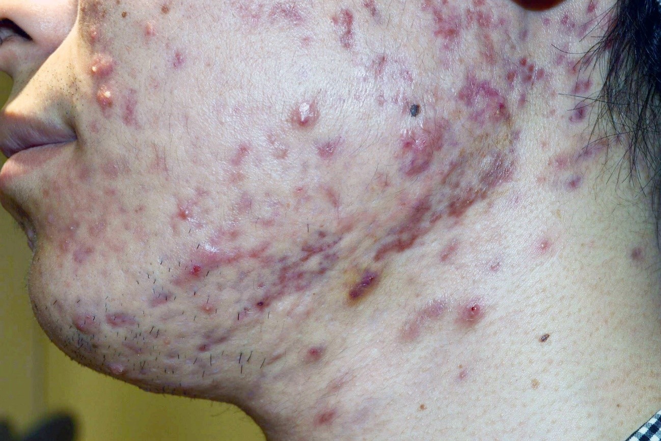 紫ニキビ は重症 皮膚科医が治療方法を写真で分かりやすく解説 基礎知識 ニキビ治療 ニキビ跡治療の東京イセアクリニック
