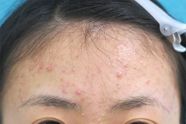 重症ニキビは治療で治る 美容皮膚科でできる治し方を徹底解説 基礎知識 ニキビ治療 ニキビ跡治療の東京イセアクリニック