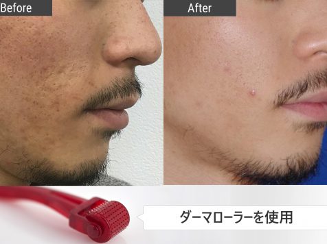 陥没したニキビ跡を治したい 治療方法を写真と図で徹底解説 基礎知識 ニキビ治療 ニキビ跡治療の東京イセアクリニック
