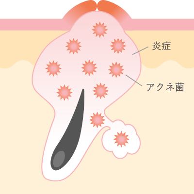 ニキビが痛い 今すぐにできるニキビの痛みの和らげ方と対処法を解説 基礎知識 ニキビ治療 ニキビ跡治療の東京イセアクリニック