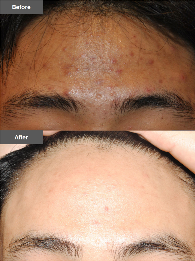 思春期ニキビの治療は美容皮膚科がお勧め 症例写真を含めて徹底解説 基礎知識 ニキビ治療 ニキビ跡治療の東京イセアクリニック