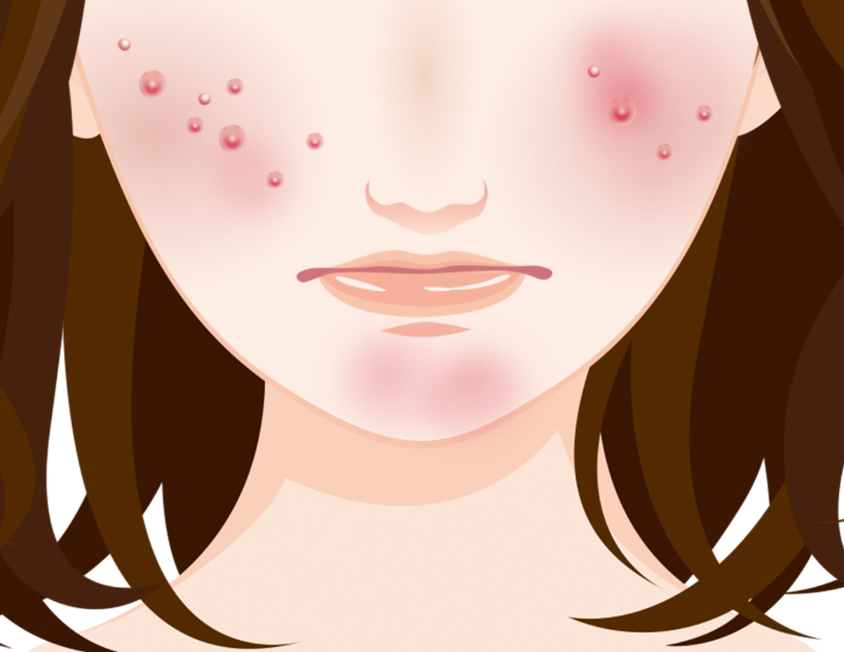 頬ニキビの原因と治療方法 基礎知識 ニキビ治療 ニキビ跡治療の東京イセアクリニック