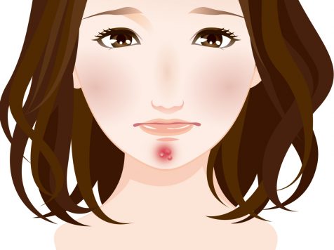 口周りのニキビを治したい人の為に 自分合った治療方法を紹介 基礎知識 ニキビ治療 ニキビ跡治療の東京イセアクリニック 口周りのニキビを治したい人の為に 自分合った治療方法を紹介 基礎知識 ニキビ治療 ニキビ跡治療の東京イセアクリニック