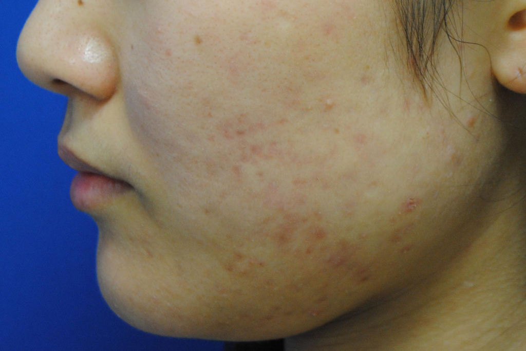 顔中にあるニキビを治すには美容皮膚科のニキビ治療 基礎知識 ニキビ治療 ニキビ跡治療の東京イセアクリニック