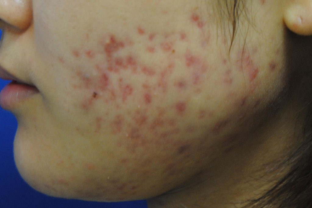 顔中にあるニキビを治すには美容皮膚科のニキビ治療 基礎知識 ニキビ治療 ニキビ跡治療の東京イセアクリニック
