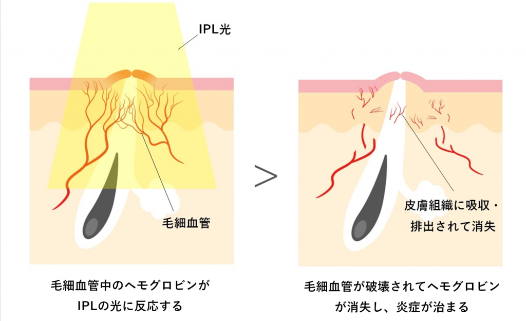 IPL光治療のイラスト説明