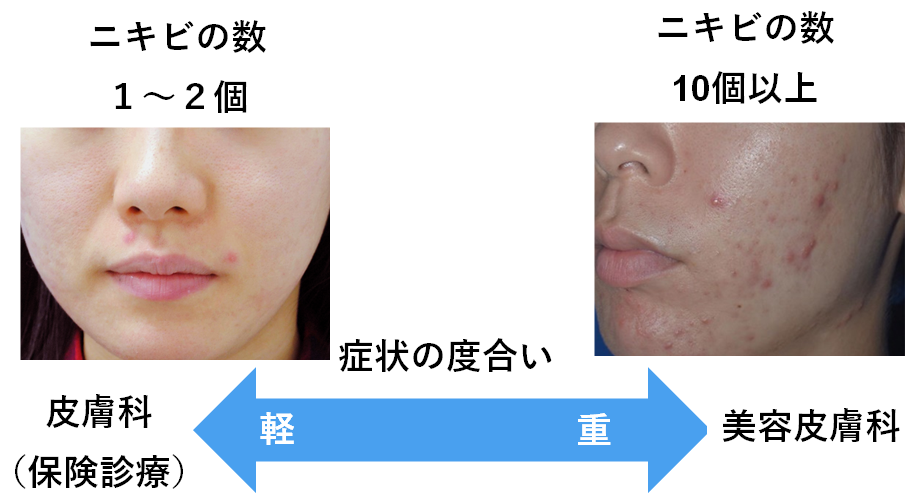 軽度と重症のニキビの図