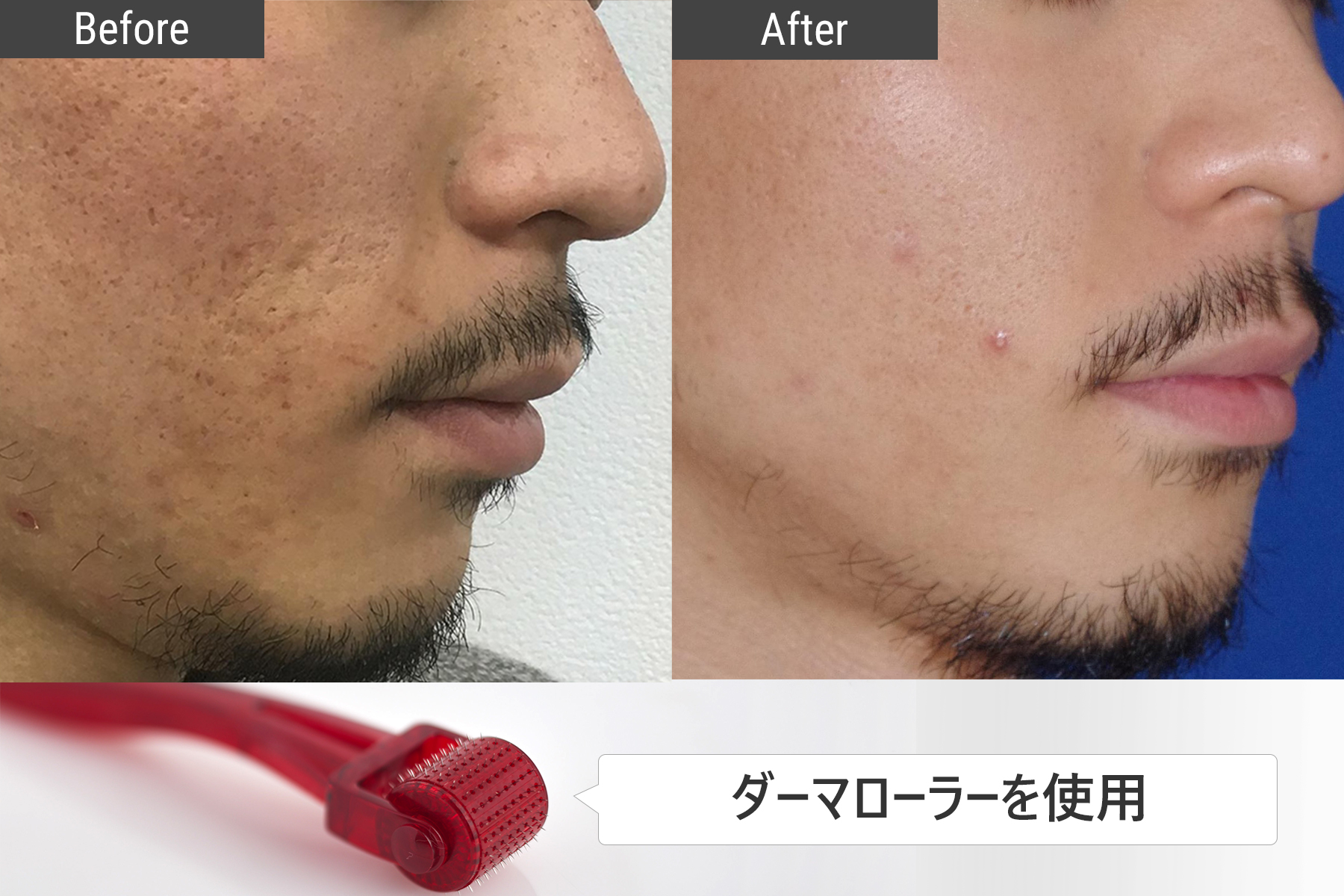 ニキビができやすい肌のケア