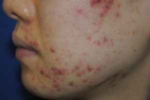 頬ニキビの原因と治療方法 | 基礎知識 | ニキビ治療・ニキビ跡治療の東京イセアクリニック