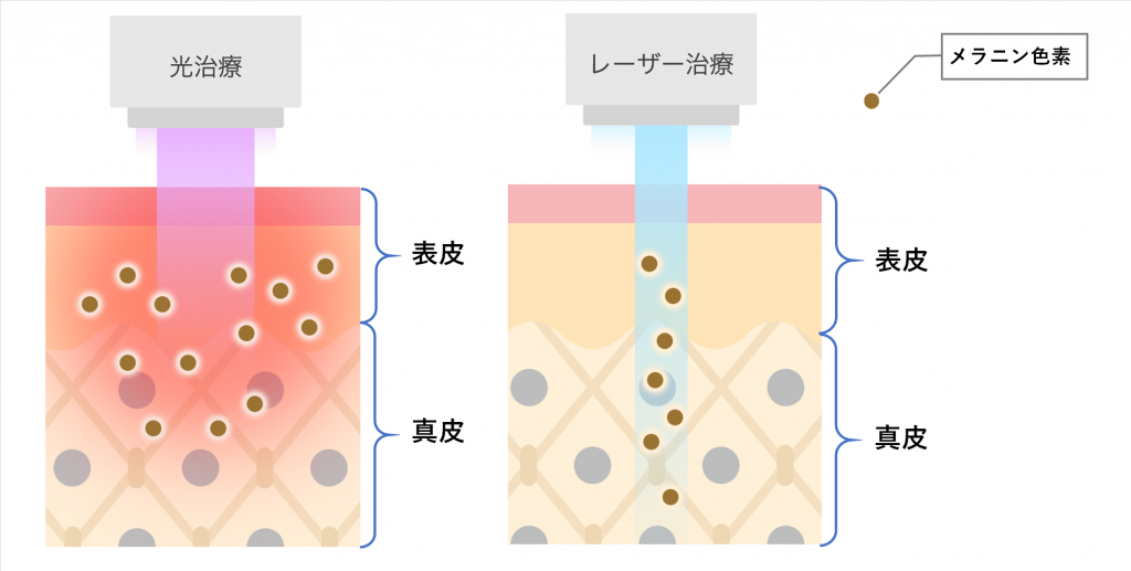 ニキビ跡に効果的な光治療って?効果やレーザーとの違いを徹底解説 | 基礎知識 | ニキビ治療・ニキビ跡治療の東京イセアクリニック