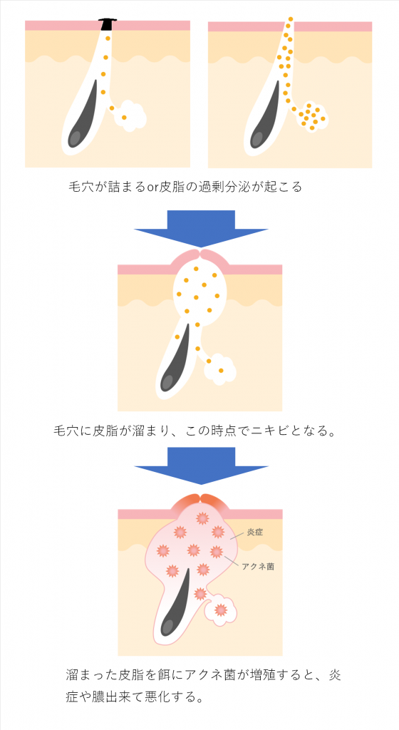 ニキビは何故できる ニキビのメカニズムをイラストと写真で解説 基礎知識 ニキビ治療 ニキビ跡治療の東京イセアクリニック