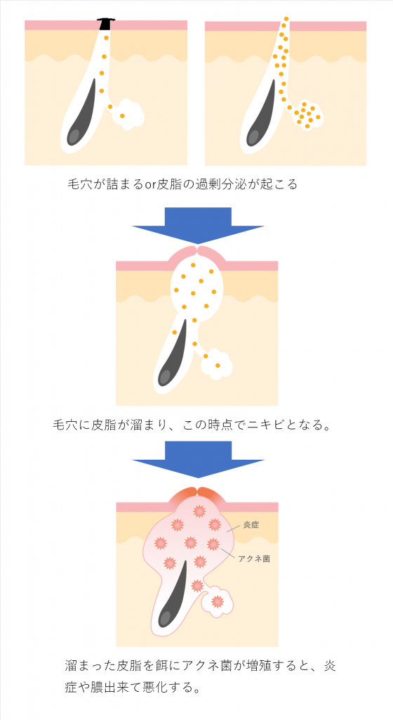 ニキビが出来るメカニズムの図