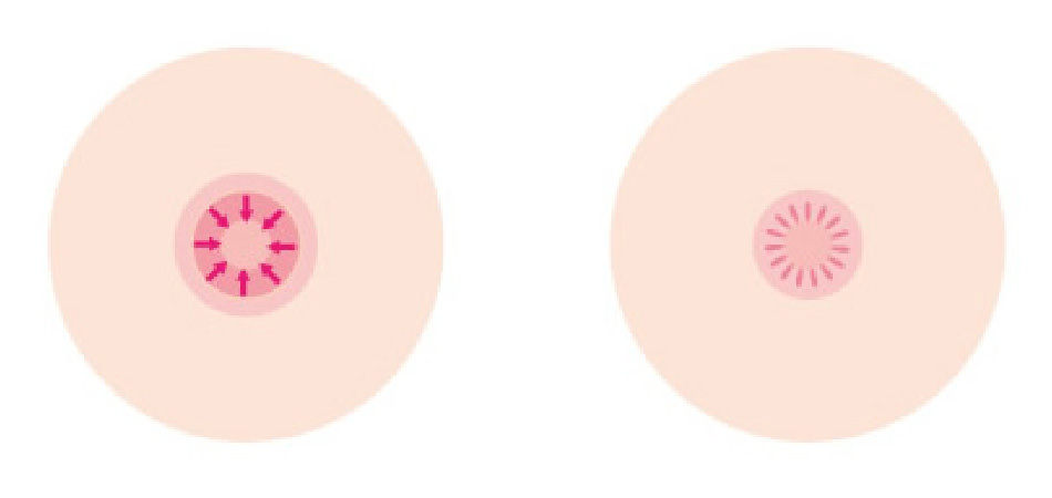 乳輪縮小