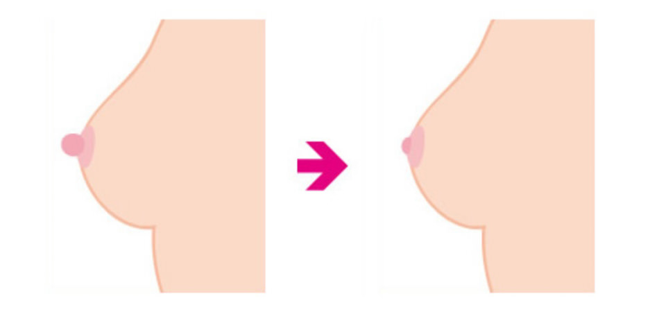乳頭縮小