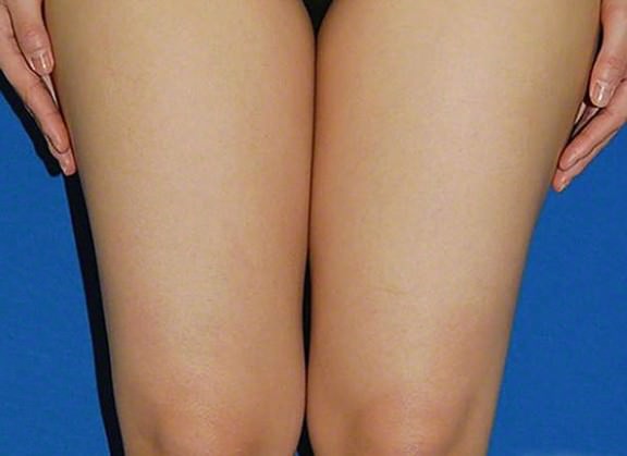 ベイザー脂肪吸引 両大腿