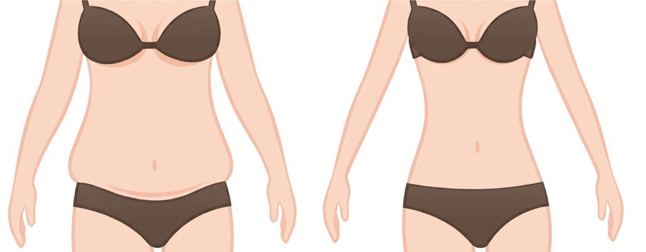 スタンダード脂肪吸引