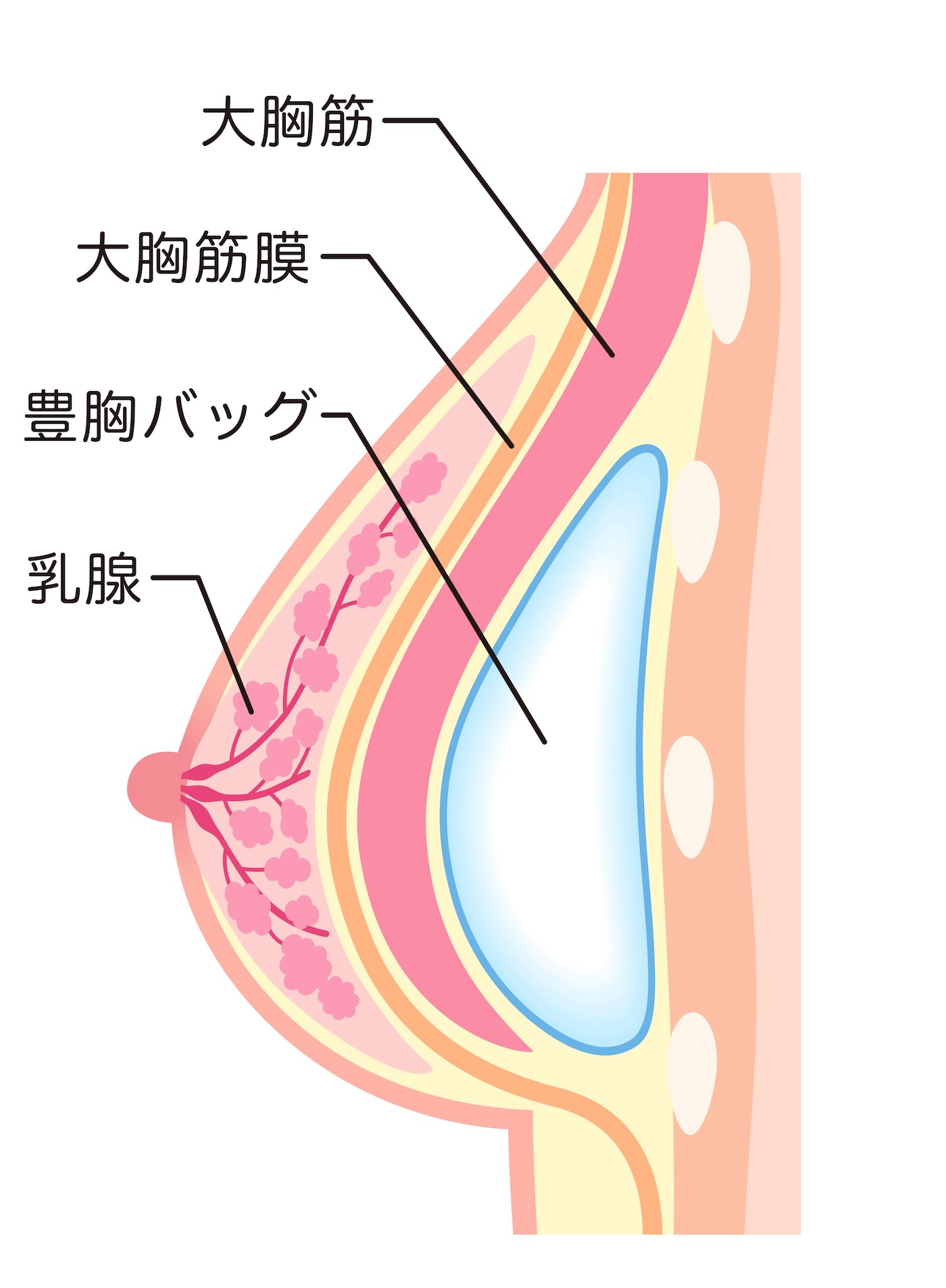 大胸筋下法