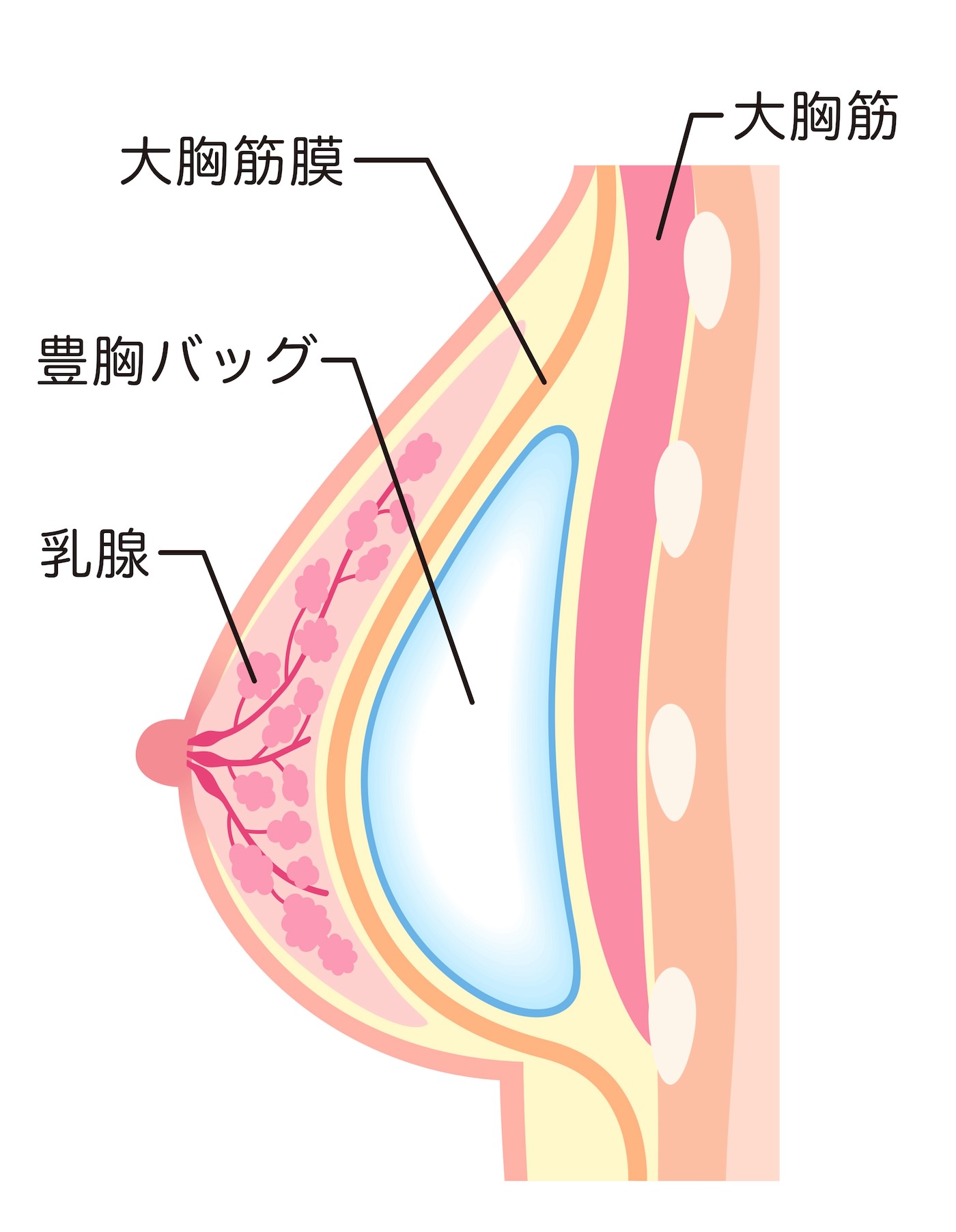 大胸筋膜下法