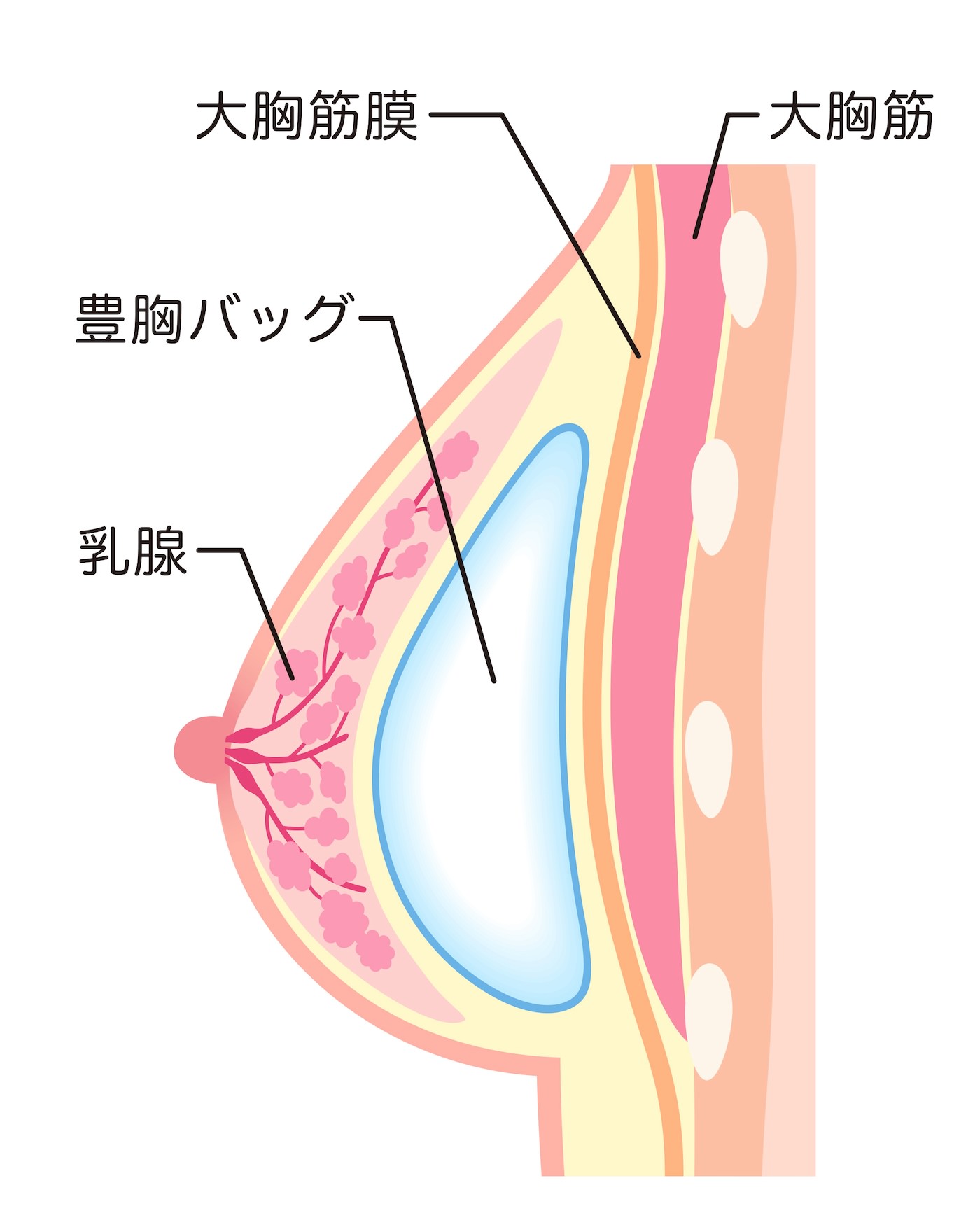 乳腺下法