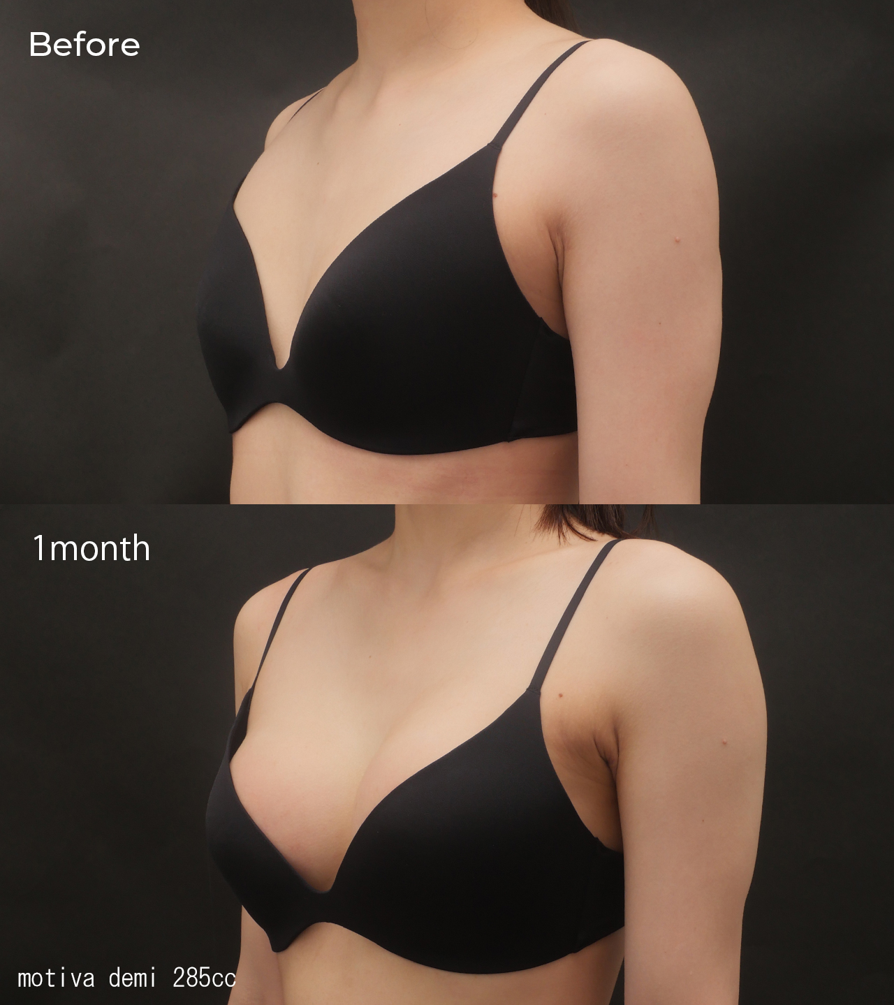 シリコンバッグ豊胸（MOTIVA）Before 1month motiva demi 285cc