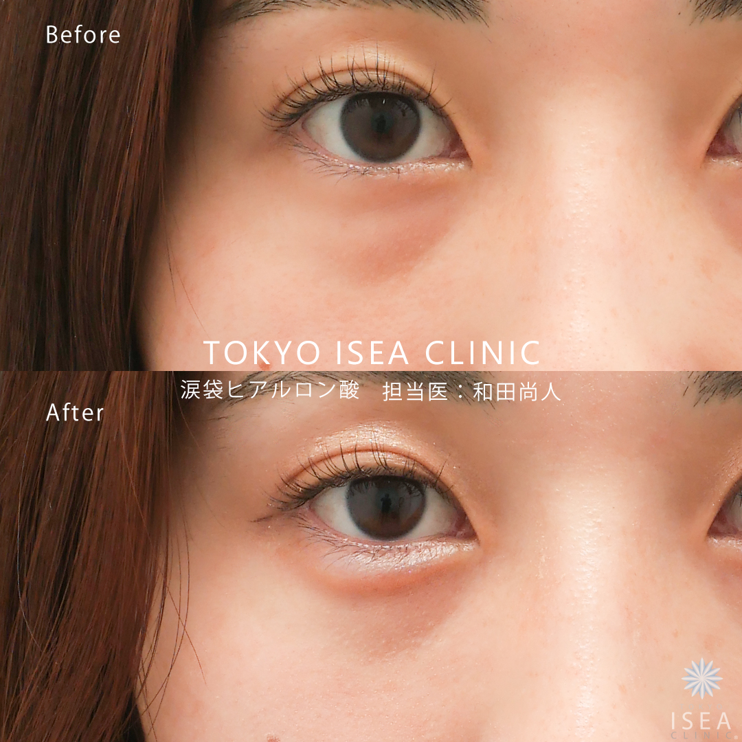 涙袋（片目0.15ccずつ）