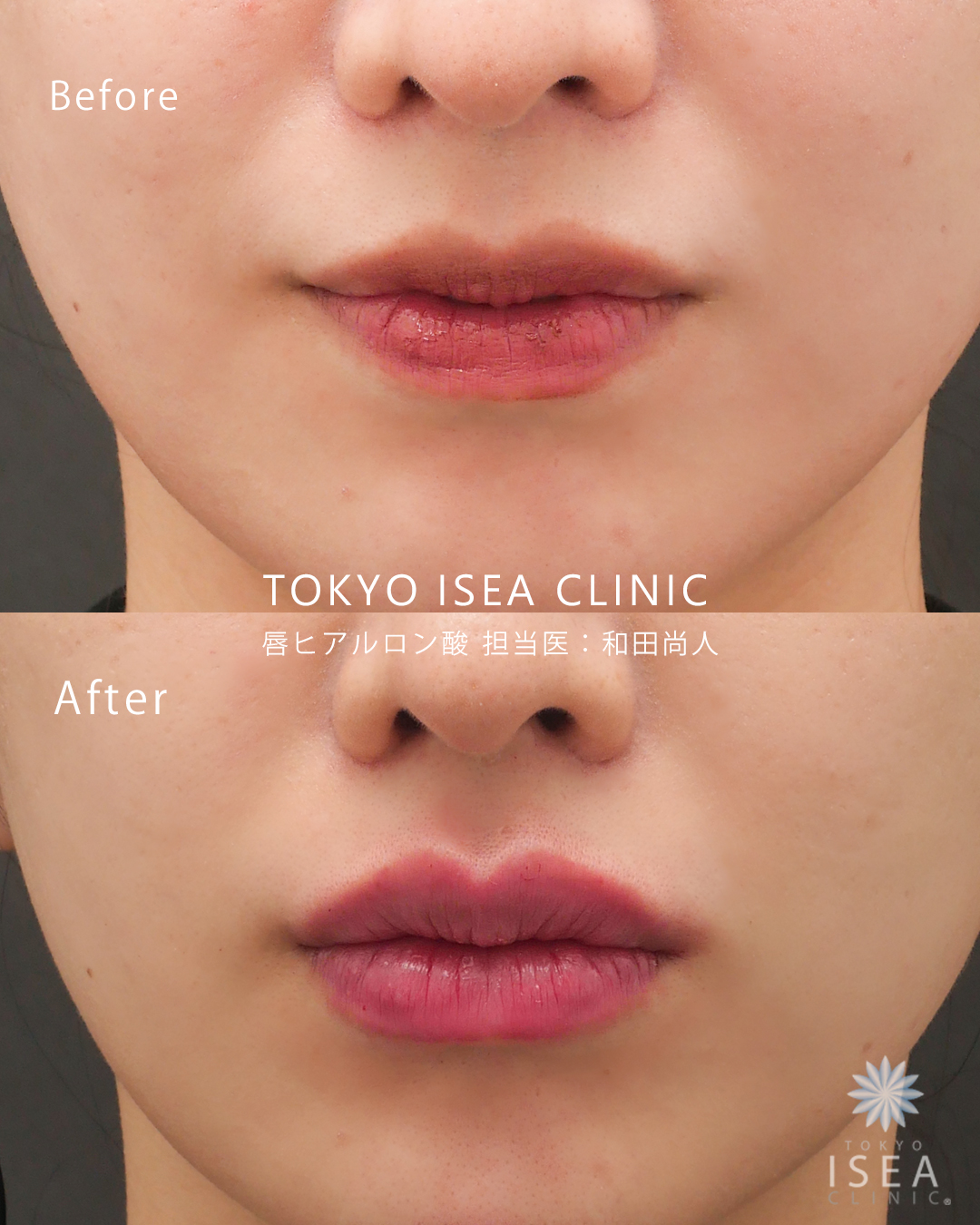 唇（上0.4cc・下0.3cc）