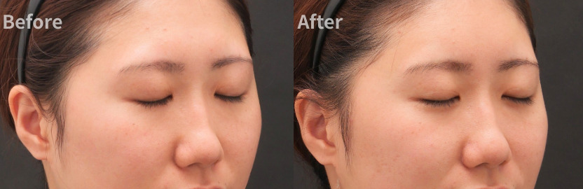 頬への注入：リフトアップしたような元気な印象に。