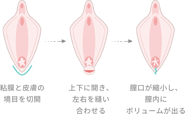 膣縮小手術 粘膜と皮膚の境目を切開 上下に開き、左右を縫い合わせる 膣口が縮小し、膣内にボリュームが出る