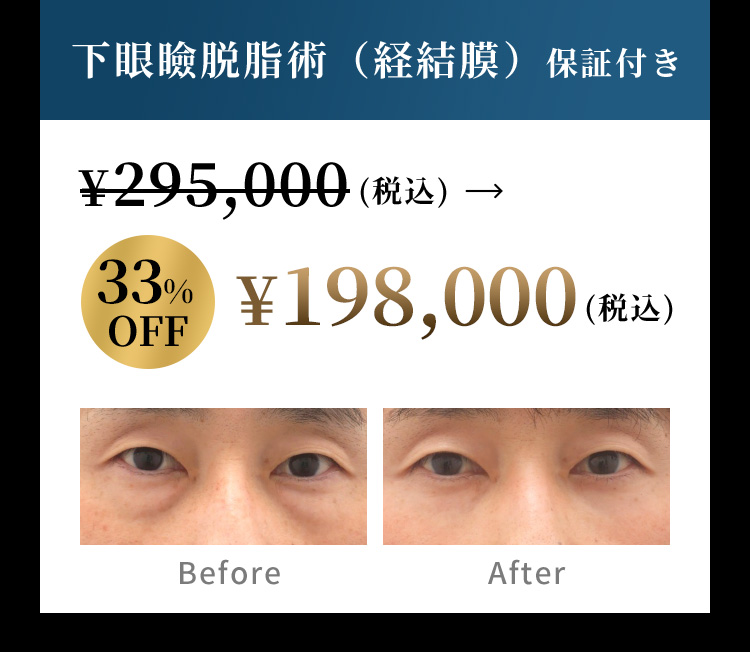 下眼瞼脱脂術（経結膜）保証付き ¥295,000(税込)→33％OFF ¥198,000(税込) Before After