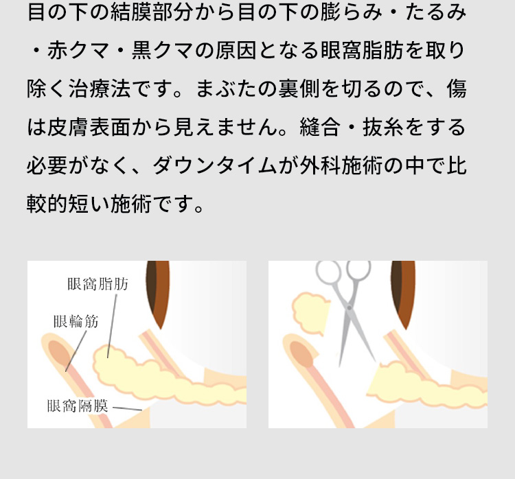 目の下の結膜部分から目の下の膨らみ、たるみ、赤クマ、黒クマの原因となる眼窩脂肪を取り除く治療法です。まぶたの裏側を切るので、傷は皮膚表面から見えません。縫合・抜糸をする必要がなく、ダウンタイムが外科施術の中で比較的短い施術です。眼窩脂肪 眼輪筋 眼窩隔膜