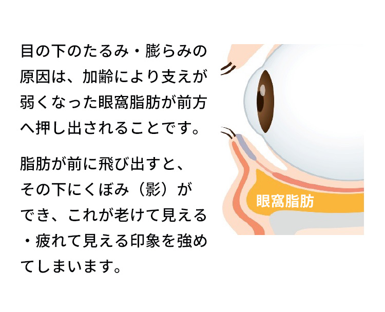 目の下のたるみ・膨らみの原因は、加齢により支えが弱くなった眼窩脂肪が前方へ押し出されることです。脂肪が前に飛び出すと、その下にくぼみ（影）ができ、これが老けて見える・疲れて見える印象を強めてしまいます。眼窩脂肪